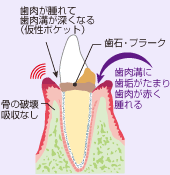 初期の歯周病状態の歯ぐきの断面図