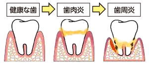健康な歯茎から歯周病になる過程のイラスト