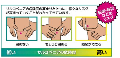 サルコペニアの危険度