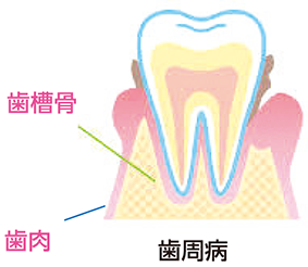 歯の病気_図