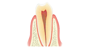 エナメル質が溶け薄くなっている歯のイラスト