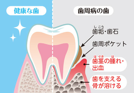 健康な歯と歯周病の歯のイラスト